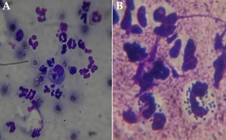 <p><strong>(A)</strong> Citología, presencia de neutrófilos degenerados, macrófagos activos. Objetivo 40x. <strong>(B) </strong>Citología, reacción piogranulomatosa, presencia de neutrófilos macrófagos con figura de fagocitosis, bacterias de tipo cocos. Objetivo 100x.</p>