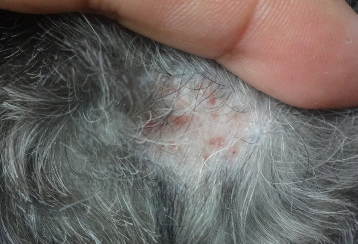 <p>Infecciones profundas en proceso de resolución 1 mes después del tratamiento.</p>