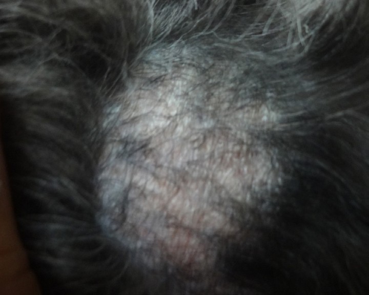 <p>Lesiones en panal de abeja en resolución con crecimiento de pelo 1 mes después del tratamiento.</p>