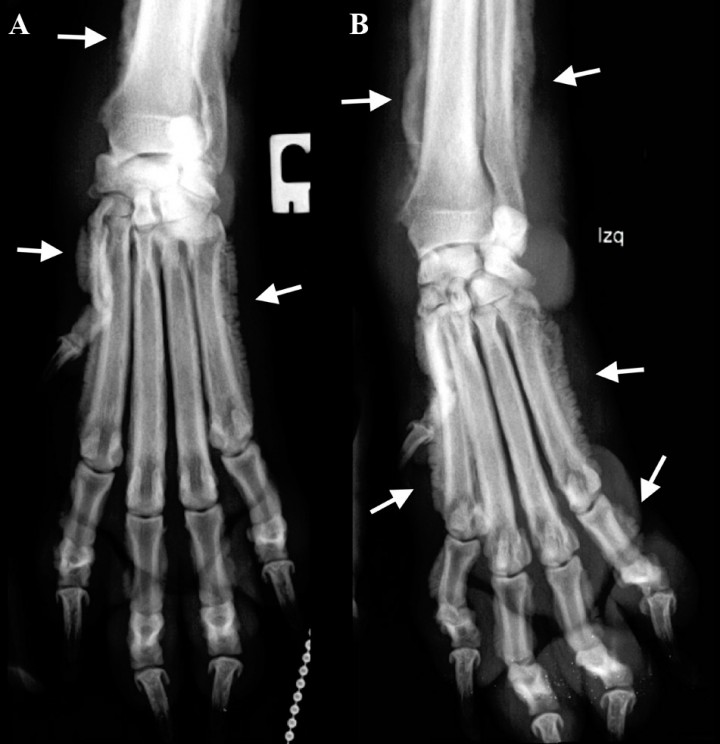 <p>Mismas radiografías de la Figura 1. Se observa reacción perióstica del tipo en empalizada (ver flechas) con afectación de la falange media de 2º dedo, en el aspecto lateral y medial de las falanges proximales (dedo I, II, III, IV, V), en el aspecto lateral del cuerpo del hueso metacarpiano I, II y V y del III y IV de forma más leve, y del tercio distal del cúbito y radio. No existe afectación de las superficies articulares ni destrucción ósea. Tumefacción de los tejidos blandos en la zona del carpo.</p>