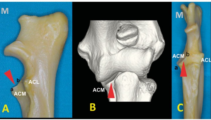 <p>Cúbito mostrado por las caras medial (<strong>A</strong>) y craneal (<strong>C</strong>) y una imagen tridimensional de un codo sano (<strong>B</strong>). Se aprecia la distinta altura de las apófisis coronoides lateral (ACL) y medial (ACM). Esta última se divide en el ápex (a) y en la base (b). Se puede observar la inclinación de la ACM (punta de flecha roja). Las lesiones de la base no se pueden apreciar en las radiografías craneocaudales, ya que se quedan superpuestas con la epífisis proximal del radio.</p>