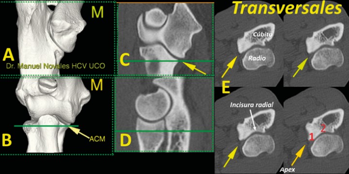 <p>Imagen tridimensional en visión caudomedial (<strong>A</strong>), craneal (<strong>B</strong>), así como en los planos dorsal (<strong>C</strong>), sagital (<strong>D</strong>) y transversales (<strong>E</strong>) a nivel de la ACM (flecha) señalado en las líneas verdes (C y D). En estos planos valoramos el ápex (1) y la incisura radial (2) (M: lado medial).</p>