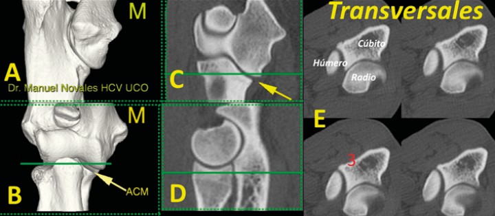 <p>Imagen tridimensional en visión caudomedial (<strong>A</strong>), craneal (<strong>B</strong>), así como en planos dorsal (<strong>C</strong>), sagital (<strong>D</strong>) y cuatro cortes transversales (<strong>E</strong>) a nivel de la ACM (flecha) señalado en las líneas verdes (C y D). En la imagen B se aprecia como la línea de corte (verde) pasa por los tres huesos del codo. En esta imagen valoramos la ausencia de reacción ósea (3) (esclerosis u osteofitos). (M: lado medial).</p>