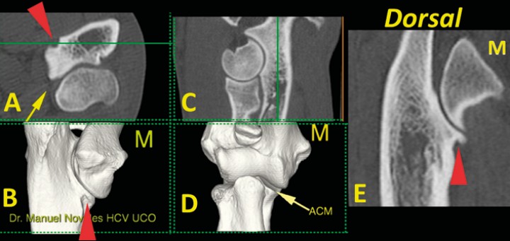 <p>Codo normal. Imágenes tridimensionales del codo en visión caudomedial (<strong>B</strong>) y craneal (<strong>D</strong>), así como planos de corte transversal (<strong>A</strong>), sagital (<strong>C</strong>) y dorsal (<strong>E</strong>). Las líneas verdes en A y C muestran el nivel al que se ha producido el plano dorsal (E). Se señala una escotadura normal (punta de flecha roja) que aparece en la porción medial de la ACM (flecha amarilla) (M: lado medial).</p>