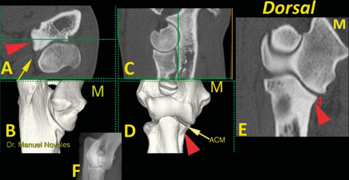 <p>Codo normal. Imágenes tridimensionales del codo en visión caudomedial (<strong>B</strong>) y craneal (<strong>D</strong>), así como planos de corte transversal (<strong>A</strong>), sagital (<strong>C</strong>) y dorsal (<strong>E</strong>). Las líneas verdes en A y C muestran el nivel al que se ha producido el plano dorsal (E). La punta de flecha roja señala la concavidad de la cara medial de la ACM (flecha amarilla) que debe ser de contorno liso (4). Se incluye una radiografía de codo en proyección craneomedial-caudolateral (F) para comparación. (M: lado medial).</p>