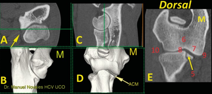 <p>Codo normal. Imágenes tridimensionales del codo en visión caudomedial (<strong>B</strong>) y craneal (<strong>D</strong>), así como planos de corte transversal (<strong>A</strong>), sagital (<strong>C</strong>) y dorsal (<strong>E</strong>). Las líneas verdes en A y C muestran el nivel al que se ha producido el plano dorsal (E). Se señala el ápex de la ACM (flecha amarilla). En este plano dorsal se valora: ACM (mediante avance del corte dorsal para valorar una posible línea de fragmentación) (5); la unión de las dos porciones del cóndilo humeral (6); la morfología normal del hueso subcondral de la porción medial del cóndilo del húmero y su grado de opacidad (7); la amplitud de los espacios articulares humero-radial y húmero-cubital (8); la ausencia de osteofitos o enteseofitos en las caras medial (9) o lateral (10) del codo. (M: lado medial).</p>