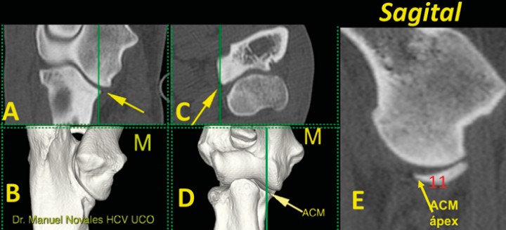 <p>Codo normal. Imágenes tridimensionales del codo en visión caudomedial (<strong>B</strong>) y craneal (<strong>D</strong>), así como planos de corte dorsal (<strong>A</strong>), transversal (<strong>C</strong>) y sagital (<strong>E</strong>). Las líneas verdes en A, C y D muestran el nivel al que se ha obtenido el plano sagital (E). Se señala el ápex de la ACM (flecha amarilla) que no debe estar fragmentado (11). (M: lado medial).</p>