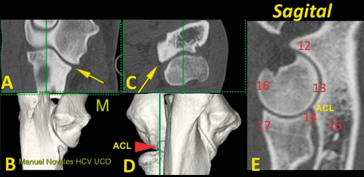 <p>Codo normal. Imágenes tridimensionales del codo en visión caudomedial (<strong>B</strong>) y craneal (<strong>D</strong>), así como planos de corte dorsal (<strong>A</strong>), transversal (<strong>C</strong>) y sagital (<strong>E</strong>). Las líneas verdes en A, C y D muestran el nivel al que se ha obtenido el plano sagital (E). Se señala la ACM (flecha amarilla) y la ACL (punta de flecha roja). En este plano dorsal se valora: la apófisis ancónea, unida y sin osteofitos (12); la congruencia articular húmero-radio-cubital (13); el escalón entre la ACL y la epífisis proximal del radio (14); el grado de esclerosis subtroclear (15); la presencia de osteofitos en la superficie craneal del cóndilo del húmero (16) o la epífisis proximal del radio (17) (M: lado medial).</p>