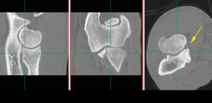 <p>Reconstrucción en 2D ortogonal clásica. Con el plano transversal obtenido, el software produce planos sagitales o dorsales. Si se observan las líneas verdes, los planos son siempre perpendiculares entre sí y, a su vez, perpendiculares al plano transversal al que tienen como referencia. No es el más adecuado para valorar la congruencia articular de superficies curvadas. Se señala la ACM (flecha amarilla).</p>
