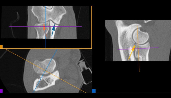 <p>Reconstrucción 3D MPR multiplanar. Esta forma de reconstrucción permite orientar los ejes según se desee. Cada eje tiene un color y produce la imagen correspondiente en el recuadro del mismo color. El eje marrón es tangencial a la ACM y ofrece la mejor vista para valorar la congruencia articular del codo. Espacio articular humero-radial (flecha roja), espacio articular húmero-cubital (flecha azul), escalón entre la apófisis coronoides lateral y la epífisis proximal del radio (flecha marrón).</p>
