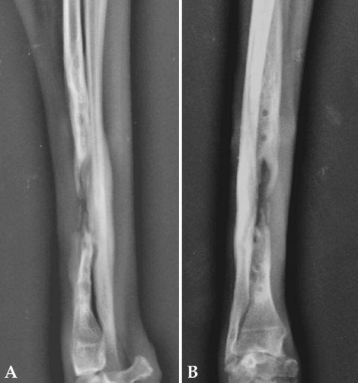<p>(<strong>A</strong>) Radiografía mediolateral. (<strong>B</strong>) Radiografía craneocaudal. Se observan claros indicios de neoformación ósea en ambos fragmentos proximal y distal (aproximadamente 1 mes después de comenzar el tratamiento con ondas de choque, día 210).</p>