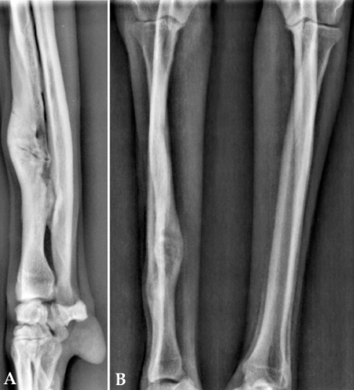 <p>(<strong>A</strong>) Proyección mediolateral. (<strong>B</strong>) Proyección craneocaudal. Detalle de la consolidación de la fractura un mes después de la última sesión de ondas de choque (día 604).</p>