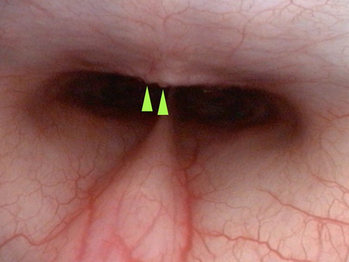 <p>Leve nasofaringitis asociada a signos de cronicidad (puntas de flecha verde)</p>