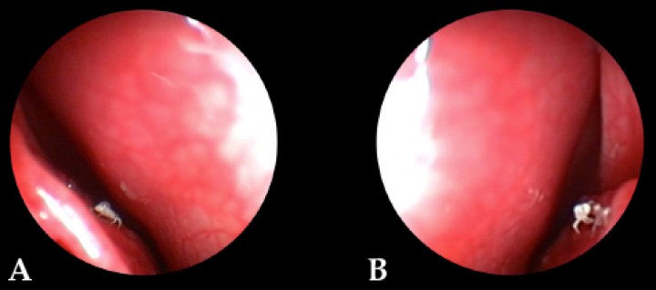 <p>Imágenes endoscópicas de la presencia de <em>P. caninum</em> en el endoturbinado derecho del paciente. (<strong>A</strong>) Meato nasal medio. (<strong>B</strong>) Meato nasal común.</p>