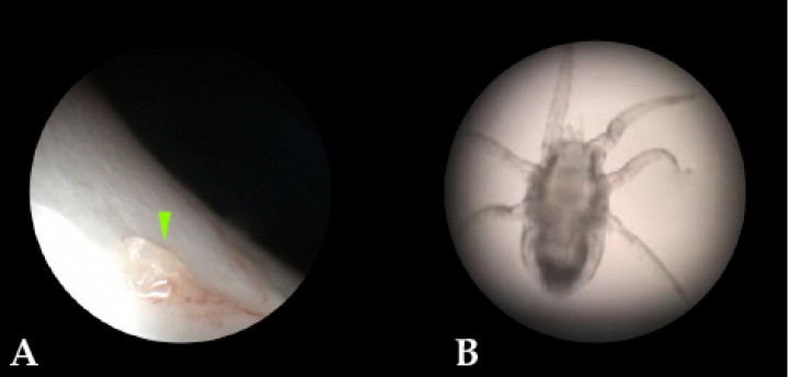 <p>Ejemplar de <em>P. caninum</em> extraído del paciente. (<strong>A</strong>) Imagen macroscópica (punta de flecha verde). (<strong>B</strong>) Imagen microscópica (40x).</p>