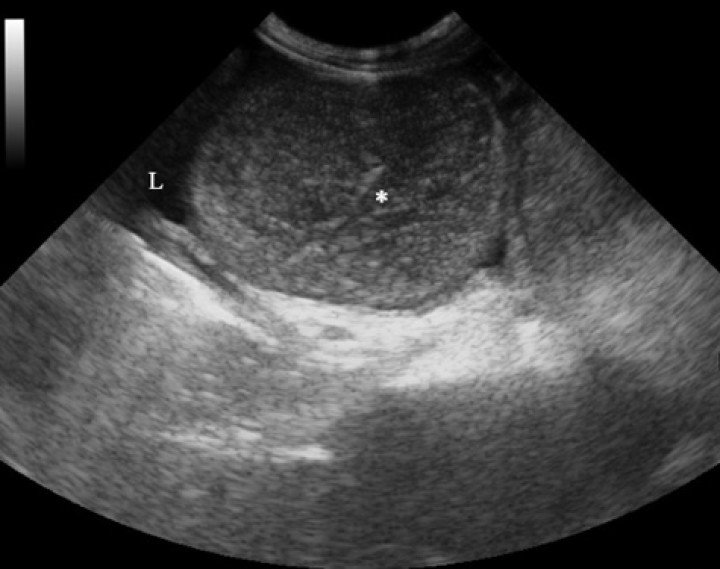 <p>Imagen ecográfica de la cavidad abdominal, en la que se visualiza líquido libre anecogénico y una asa intestinal en corte transversal, dilatada y con contenido heterogéneo e hipoecogénico en su interior (*).</p>