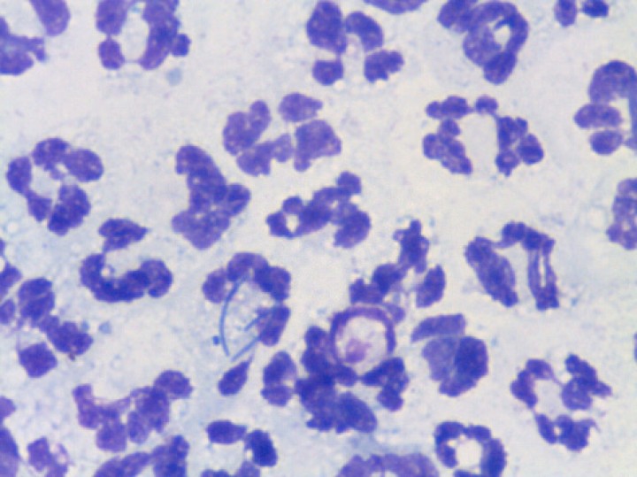 <p>Imagen de la citología que evidencia la presencia de neutrófilos degenerados y algunas bacterias fagocitadas. 100x. Tinción panóptico rápido.</p>