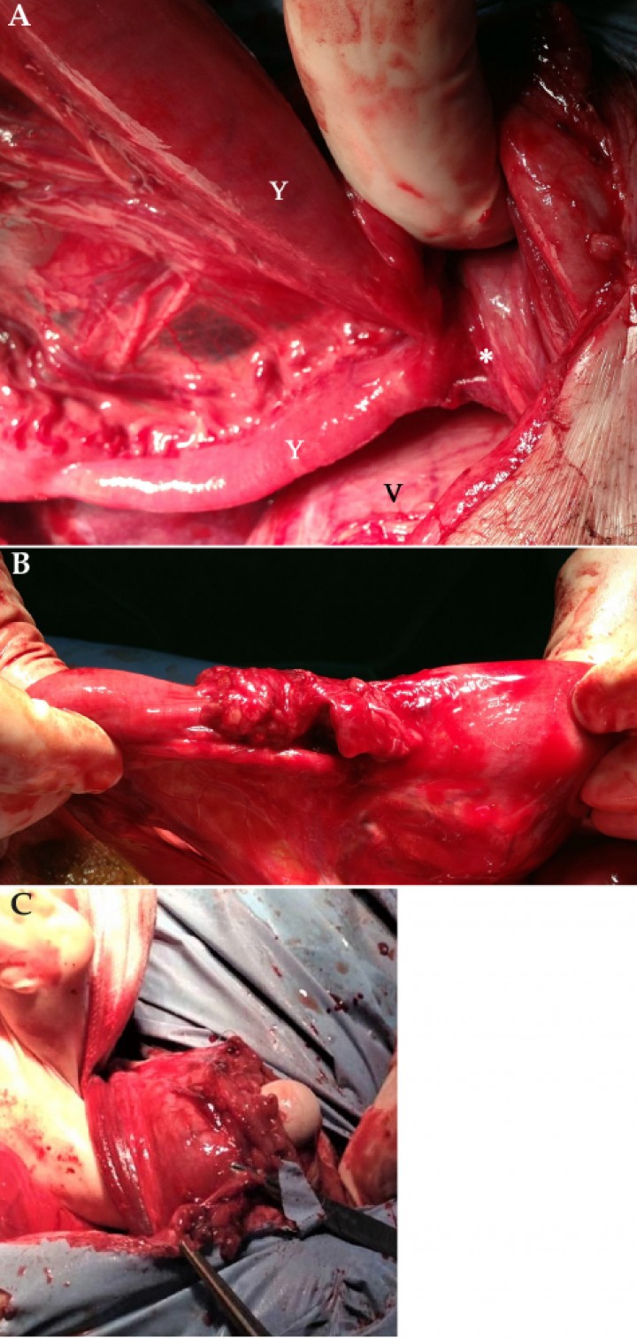 <p>Imágenes de la intervención quirúrgica. (<strong>A</strong>) Detalle del asa intestinal incarcerada (Y) en la que se observa cómo se introduce hacia un defecto en la pared abdominal (asterisco), adyacente a la vejiga de la orina (V). (<strong>B</strong>) Asa intestinal incarcerada, una vez liberada de su incarceración en la pared abdominal. (<strong>C</strong>) Defecto de la pared abdominal, en el lateral derecho del prepucio, donde se encontraba incarcerada el asa intestinal.</p>