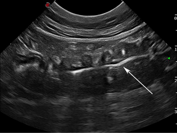 <p>Imagen ecográfica de una asa de intestino delgado. Se visualiza el intestino plicado y en el interior una línea hiperecogénica consistente con un cuerpo extraño lineal (flecha blanca).</p>