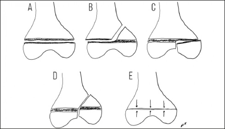 <p>Clasificación Salter-Harris de las fracturas fisarias. A) Tipo I: la fractura que discurre a través de la línea de crecimiento. B) Tipo II: la fractura se extiende desde la línea de crecimiento a la metáfisis. C) Tipo III: la fractura se extiende desde la línea de crecimiento a la epífisis. D) Tipo IV: la fractura discurre a través de la metáfisis, línea de crecimiento y epífisis. E) Tipo V: la fractura conlleva una compresión de la línea de crecimiento. Los tipos I y II son fracturas extraarticulares y los tipos III y IV son articulares.</p>