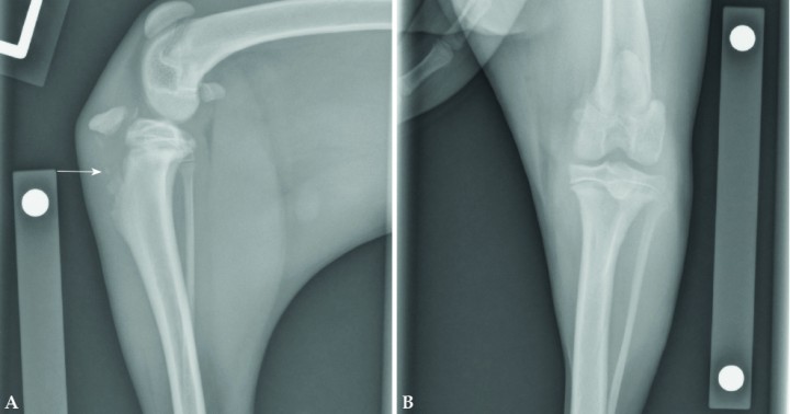 <p>Imágenes radiográficas de un cachorro de 6 meses con una fractura de la tuberosidad tibial (TT). Véase el desplazamiento proximal de la tuberosidad tibial (Fig. 3A) como consecuencia de la tracción del ligamento rotuliano. Es muy importante evaluar la proyección craneocaudal (Fig. 3B) para un completo estudio radiológico. Si se compara con el miembro derecho se podría apreciar una localización de la tuberosidad tibial más proximal, así como un desplazamiento proximal de la rótula. Su tratamiento es generalmente quirúrgico con la estabilización de la TT con agujas de Kirschner y un cerclaje (banda de tensión). En animales muy jóvenes puede ser necesaria la retirada de los implantes para evitar un cierre fisario prematuro y desplazamiento distal de la TT.</p>
