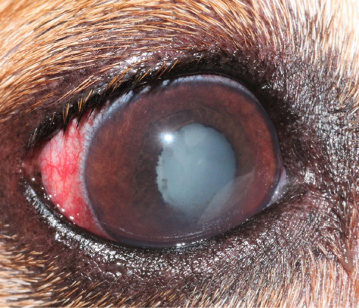 <p>Uveítis inducida por el cristalino con congestión conjuntival, pigmento en cápsula anterior del cristalino y precipitados queráticos en un paciente con catarata madura.</p>