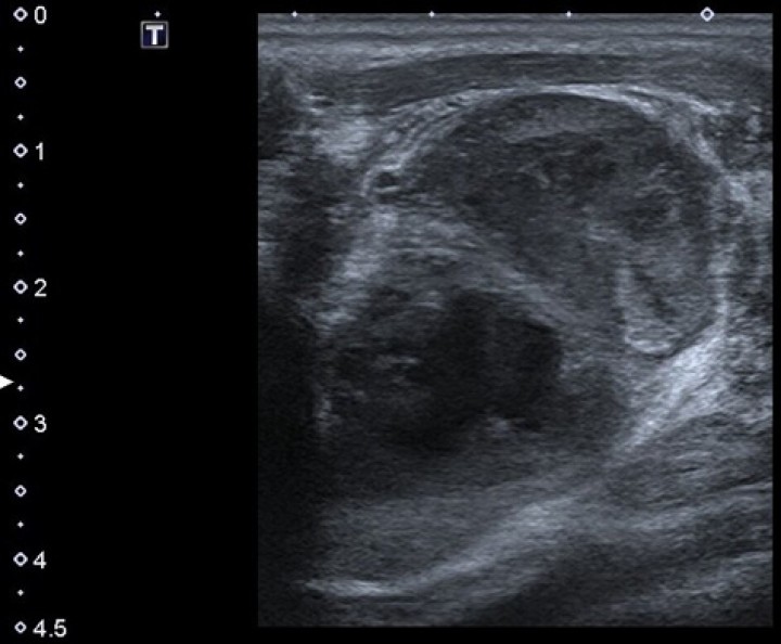 <p>Ecografía cervical. Incremento del linfonodo retrofaríngeo izquierdo (3,9 x 1,9 cm) con parénquima heterogéneo y presencia de dos cavidades con contenido líquido levemente hiperecoico.</p>