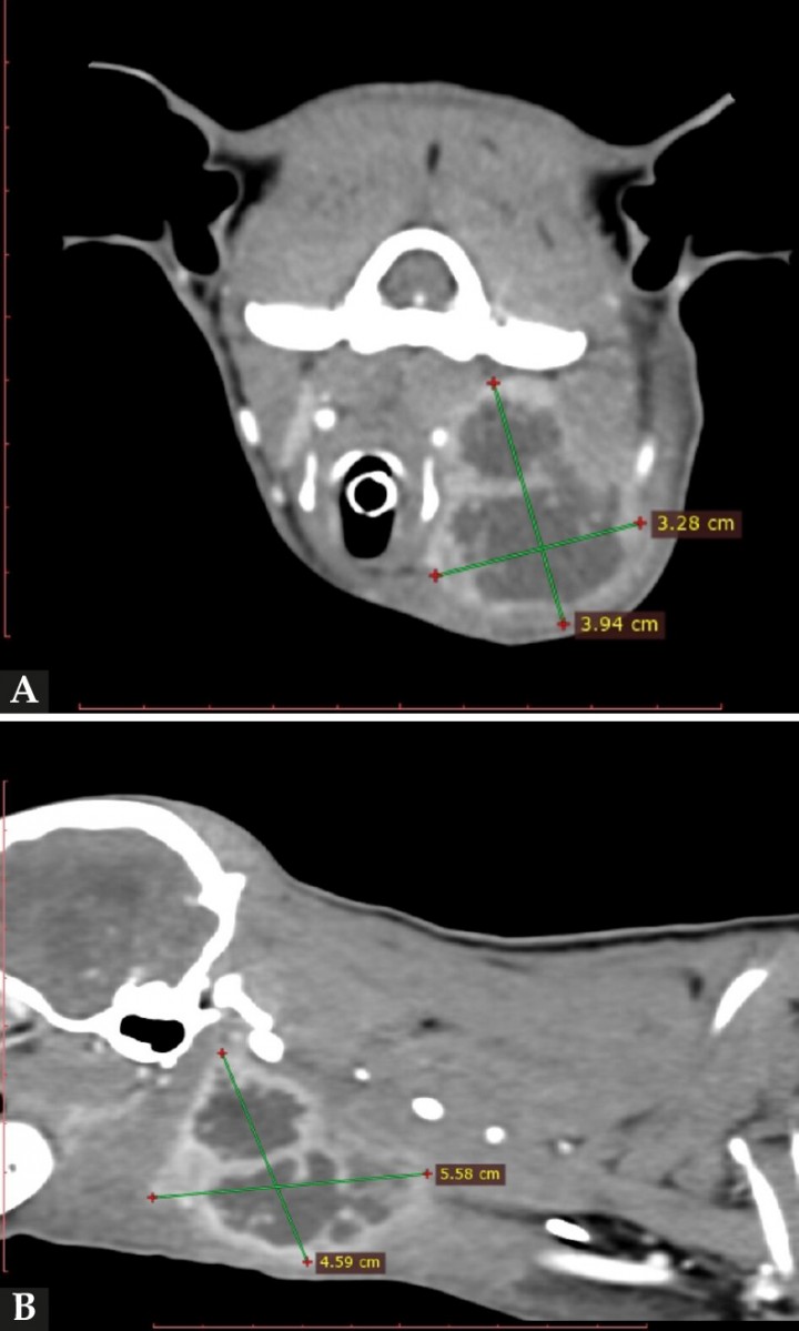 <p>(<strong>A</strong>) TC, corte axial. Nótese que la masa cervical tiene origen en linfonodo retrofaríngeo izquierdo. (<strong>B</strong>) TC, corte sagital. Véase la misma lesión, alcanzando un tamaño de 5,58 x 4,59 cm.</p>