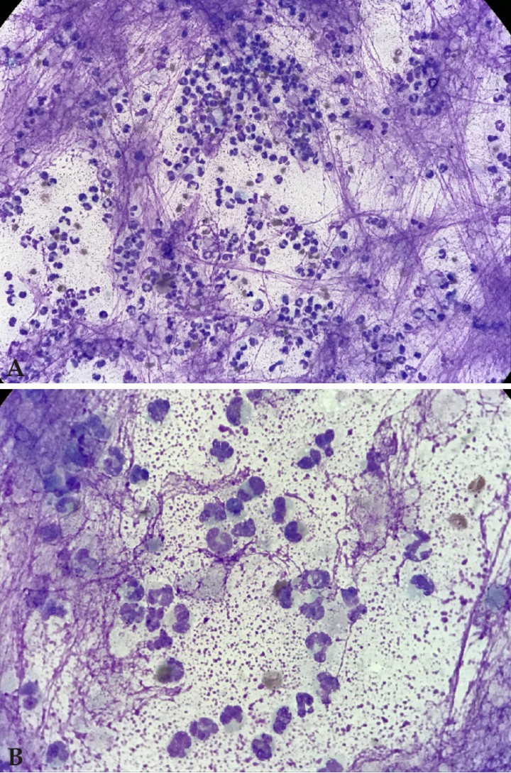 <p>(<strong>A</strong>) Microfotografía de extensión citológica de la masa submandibular, mostrando inflamación neutrofílica. (<strong>B</strong>) Se aprecian con mayor detalle numerosos neutrófilos degenerados. (Diff-Quik; objetivos de 40x y 100x).</p>