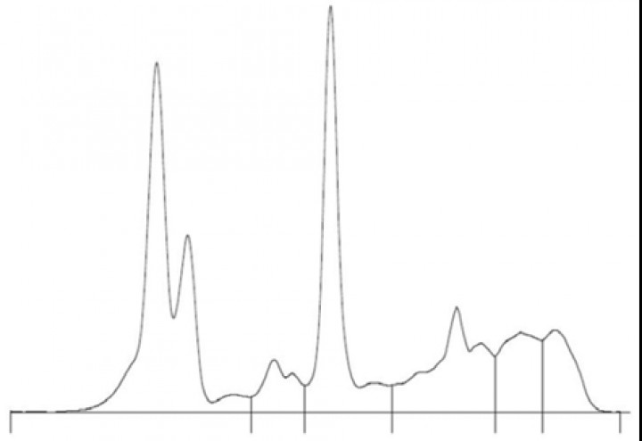 <p>Electroforesis de proteínas séricas.</p>