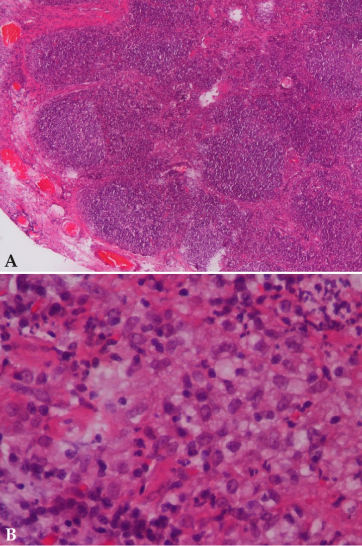 <p>(<strong>A</strong>) Microfotografía de sección tisular de la masa, mostrando estructura histológica de linfonodo. (<strong>B</strong>) Se observa imagen a mayores aumentos, consistente con linfadenitis neutrofílica. (Hematoxilina-Eosina; objetivos de 10x y 40x).</p>