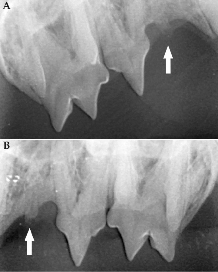 <p>(<strong>A</strong>) Radiografía dental extraoral de la arcada maxilar derecha. Se observa alteración radiológica compatible con RD de tipo 2 del 106 (flecha). (<strong>B</strong>) Radiografía dental extraoral de la arcada maxilar izquierda. Se observa alteración radiológica compatible con RD de tipo 2 del 206 (flecha).</p>