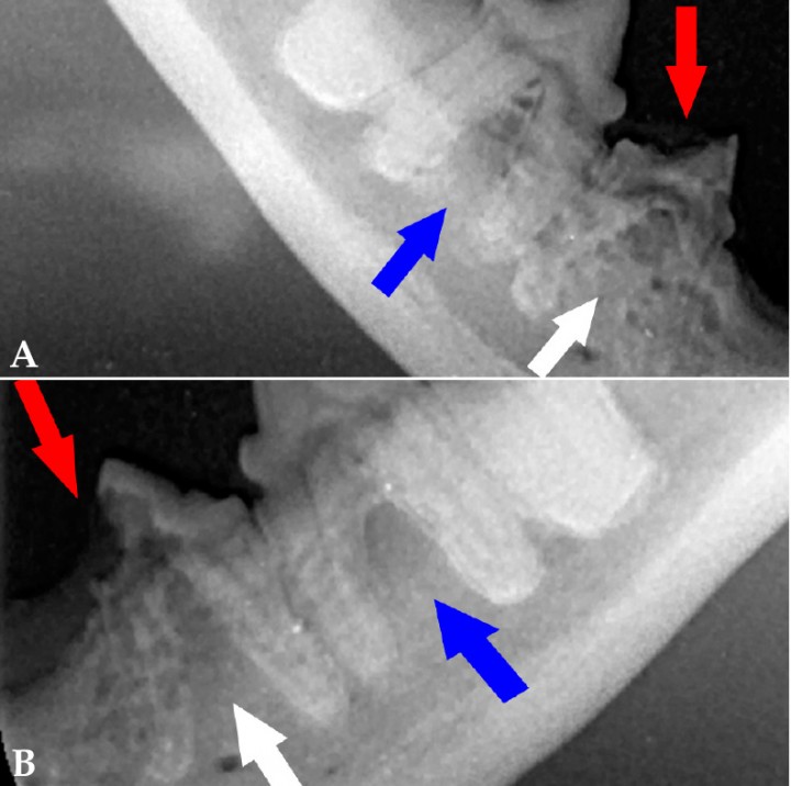 <p>(<strong>A</strong>) Radiografía dental intraoral de los premolares y molar mandibulares derechos. Se observa pérdida de tejido duro del diente a nivel de la cara distal de la corona de 407 (flecha roja) y cierto grado de anquilosis a nivel radicular (flecha blanca), hallazgos radiológicos compatibles con RD de tipo 3. Existe cierto grado de anquilosis a nivel radicular en 408, compatible con RD tipo 2 (flecha azul). (<strong>B</strong>) Radiografía dental intraoral de los premolares y molar mandibulares izquierdos. Se observa pérdida de tejido duro del diente a nivel de la cara mesial de la corona de 307 (flecha roja) y cierto grado de anquilosis a nivel radicular (flecha blanca), hallazgos radiológicos compatible con RD de tipo 3. Existe cierto grado de anquilosis a nivel radicular en 308, compatible con RD tipo 2 (flecha azul).</p>