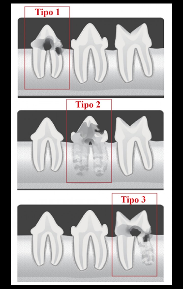 <p>Clasificación del Colegio Americano de Odontología Veterinaria (AVDC) de las reabsorciones dentales felinas en función de su imagen radiológica.</p>