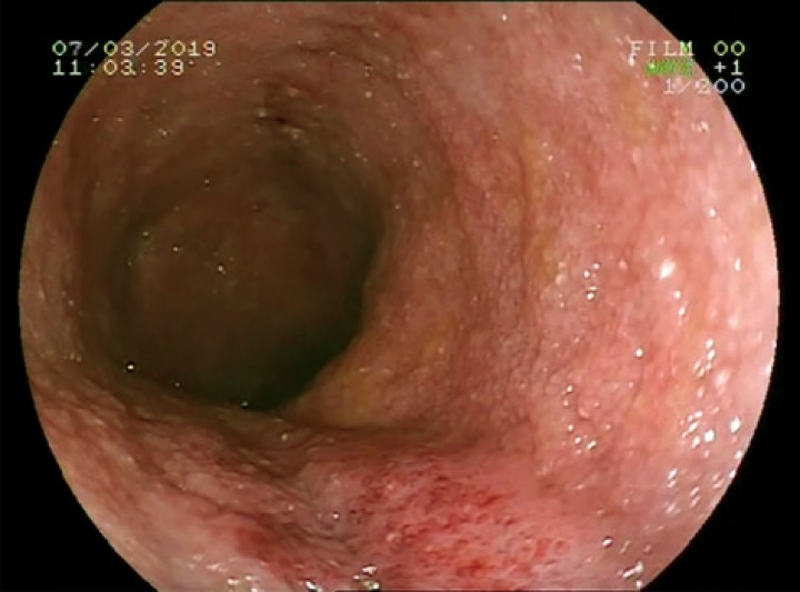 <p>Imagen endoscópica del duodeno con granularidad ligeramente aumentada.</p>