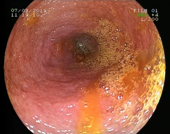 <p>Imagen endoscópica del íleon con granularidad ligeramente aumentada.</p>