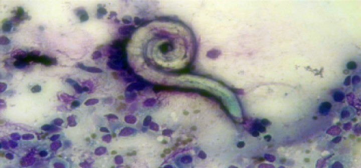 <p>Muestra citológica obtenida mediante lavado broncoalveolar. Se observa en el centro de la imagen una larva de <em>Aelurostrongylus abstrusus</em>. Tinción Diff-Quik y aumentos totales x100.</p>
