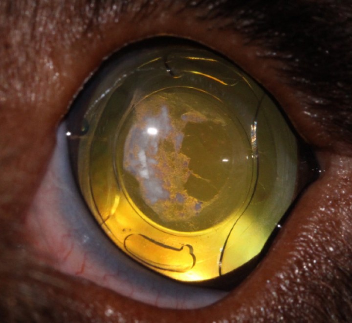 <p>Imagen postquirúrgica de cirugía de facoemulsificación con opacidad posterior de la cápsula y capsulorrexis posterior.</p>