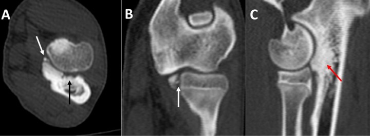 <p>Labrador macho de 8 meses con cojera bilateral. Codo derecho. Planos transversal (<strong>A</strong>), dorsal (<strong>B</strong>) y sagital (<strong>C</strong>). Se indica la fragmentación de la apófisis coronoides medial (flechas blancas). La escotadura radial aparece muy irregular (flecha negra) y presenta esclerosis de la escotadura subtroclear del cúbito (flecha roja). Existe una buena congruencia articular.</p>
