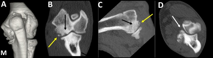 <p>Labrador Retriever macho de 5 meses, con cojera unilateral intermitente del codo izquierdo. Imagen en 3D del codo, en vista caudal (<strong>A</strong>) y planos dorsal (<strong>B</strong>), sagital (<strong>C</strong>) y transversal (<strong>D</strong>). Osteocondrosis del cóndilo humeral, con abundante hueso esclerótico (flechas negras) y un fragmento osteocondral desprendido del cóndilo (flecha amarilla). Se señala la fragmentación de la apófisis coronoides medial del cúbito (flecha blanca). Existe artrosis avanzada, especialmente manifiesta en la cara medial del codo (M).</p>