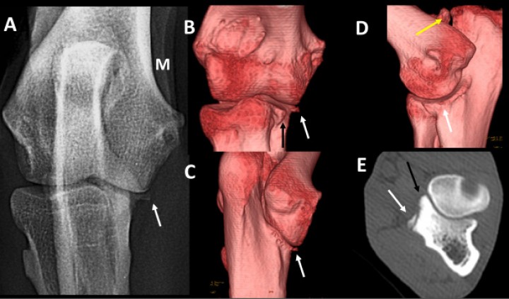 <p>Cruzado macho de 36 meses con dolor en el codo izquierdo. Radiografía craneocaudal (<strong>A</strong>) e imágenes en 3D del codo por las caras craneal (<strong>B</strong>), caudomedial (<strong>C</strong>) y medial (<strong>D</strong>). Plano transversal a la altura de la apófisis coronoides medial (<strong>E</strong>). Se señala la posición de la apófisis coronoides medial (flechas negras) y del osteofito localizado en la porción distal de la escotadura troclear del cúbito (flechas blancas). Es evidente la no unión del proceso ancóneo (flecha amarilla).</p>