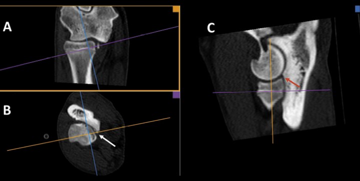 <p>Pastor Alemán macho de 9 meses. Planos dorsal (<strong>A</strong>), transversal (<strong>B</strong>) y sagital (<strong>C</strong>). Reconstrucción 3D MPR multiplanar para conseguir planos oblicuos. Con este tipo de reconstrucción cada eje tiene un color y produce la imagen en el recuadro del color correspondiente. Existe una fragmentación de la apófisis coronoides medial del cúbito (flecha blanca). En B se ha orientado la línea azul para conseguir el plano sagital perpendicular a la apófisis coronoides (C). En el plano sagital se aprecia un marcado escalón (de 2,6 mm) entre la apófisis coronoides lateral y la epífisis proximal del radio (flecha roja) lo que indica que existe una incongruencia articular.</p>