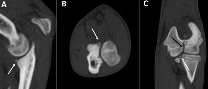 <p>Labrador Retriever, hembra de 6 meses, con cojera crónica intensa del miembro anterior izquierdo. Planos sagital (<strong>A</strong>), transversal (<strong>B</strong>) y dorsal (<strong>C</strong>). Es visible la fragmentación de la apófisis coronoides medial del cúbito (flechas blancas), así como la osificación incompleta del cóndilo del húmero (flecha negra).</p>
