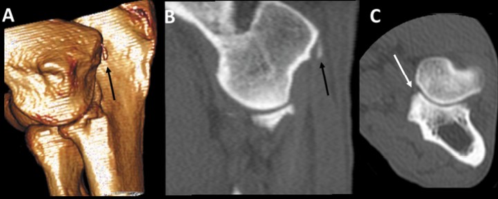 <p>Pastor Alemán hembra de 8 meses, con cojera de dos semanas y dolor en el codo derecho. Imágenes en 3D del codo por la cara medial (<strong>A</strong>) y planos sagital (<strong>B</strong>) y transversal (<strong>C</strong>). La apófisis coronoides medial del cúbito muestra un pequeño fragmento hipoatenuante (flecha blanca) que se confirmó mediante artroscopia. Además, existe un pequeño fragmento hiperatenuante próximo al borde caudodistal del epicóndilo medial del húmero, que no va acompañado de reacción ósea (flechas negras). Esta estructura asociada al tendón flexor es seguramente un fragmento avulsionado, indicativo de una desmopatía crónica.</p>