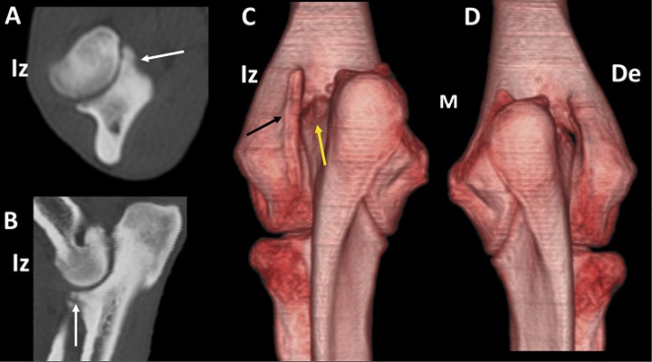 <p>Podenco macho de 42 meses con cojera bilateral por fragmentación de las apófisis coronoides medial de ambos codos. Planos transversal (<strong>A</strong>) y sagital (<strong>B</strong>) del codo izquierdo (Iz) que muestra fragmentación de la apófisis coronoides medial del cúbito (flechas blancas). Imágenes en 3D en vistas caudales de los codo izquierdo (<strong>C</strong>) y derecho (<strong>D</strong>). Existe una importante remodelación del epicóndilo lateral izquierdo (C) (flecha negra) acompañada de remodelación de la apófisis ancónea (flecha amarilla). Se muestra el codo derecho (De) para comparación.</p>