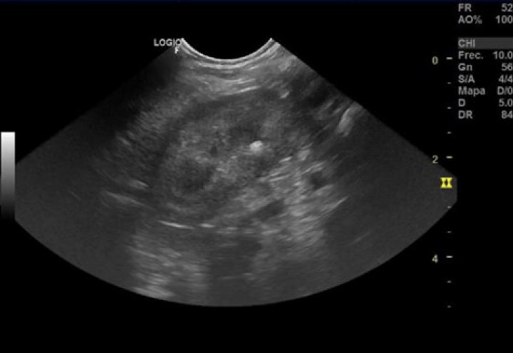 <p>Imagen de un corte sagital del riñón derecho, en el que puede apreciarse una estructura hiperecogénica en la zona de la pelvis renal.</p>