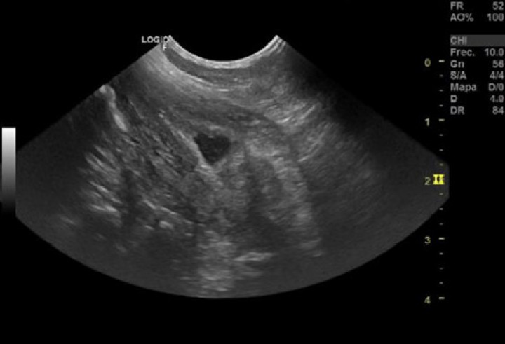 <p>Corte sagital de la vejiga de orina, en el que podemos apreciar la inexistencia de suficiente orina para ser valorada correctamente.</p>