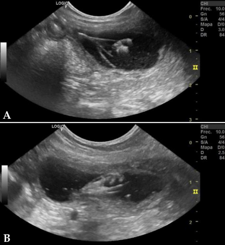 <p>(<strong>A</strong>) Imagen ecográfica de un corte sagital de la vejiga, apreciándose una estructura ramificada hiperecogénica con aspecto de espiga en su interior. (<strong>B</strong>) Imagen ecográfica de un corte sagital de la vejiga, apreciándose desde otro ángulo la estructura hiperecogénica ramificada compatible con cuerpo extraño de origen vegetal (espiga).</p>