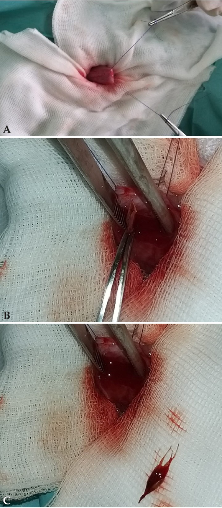 <p>(<strong>A</strong>) Exposición de la vejiga de la orina mediante abordaje parapeneano para el procedimiento quirúrgico. (<strong>B</strong>) Momento intraquirúrgico de extracción del cuerpo extraño a través de la cistotomía realizada. (<strong>C</strong>) Detalle intraquirúrgico del aspecto del cuerpo extraño (espiga) extraído.</p>