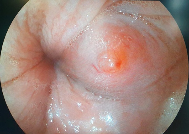 <p>Imagen de endoscopia esofágica. Lesión localizada craneal al hiato esofágico. Se observa un nódulo de consistencia firme con lesión puntiforme (flechas).</p>